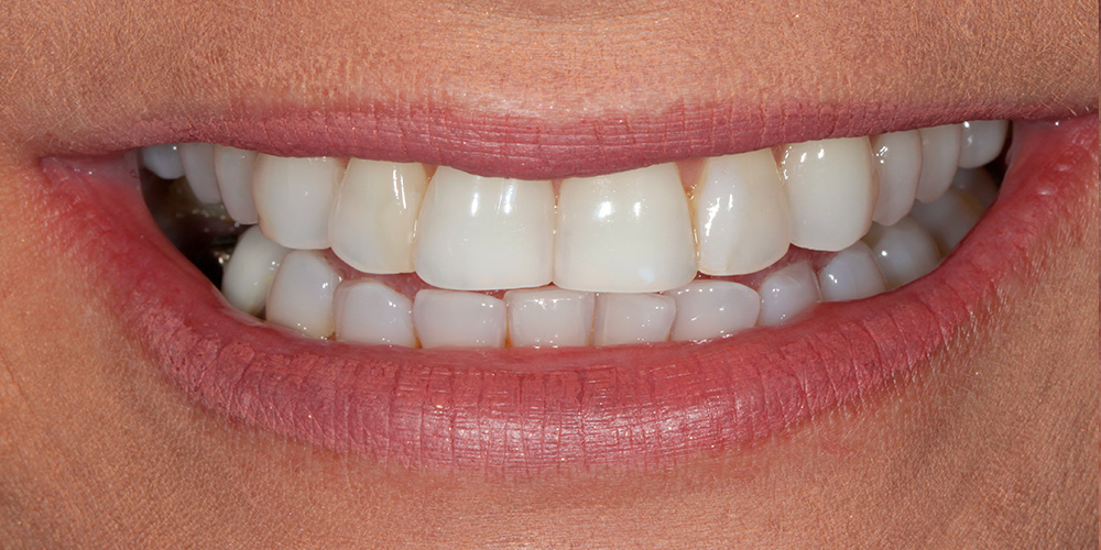 Sorriso antes do tratamento