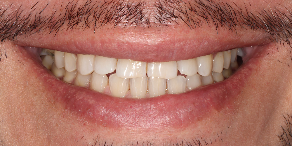 Sorriso antes do tratamento