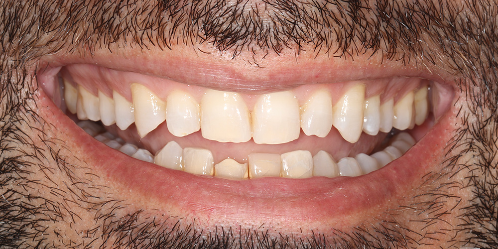 Sorriso antes do tratamento
