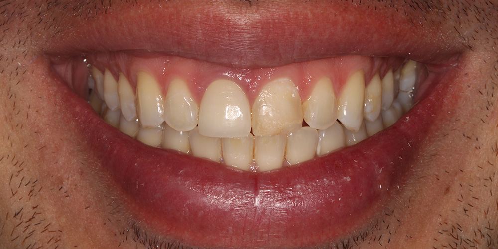 Sorriso antes do tratamento