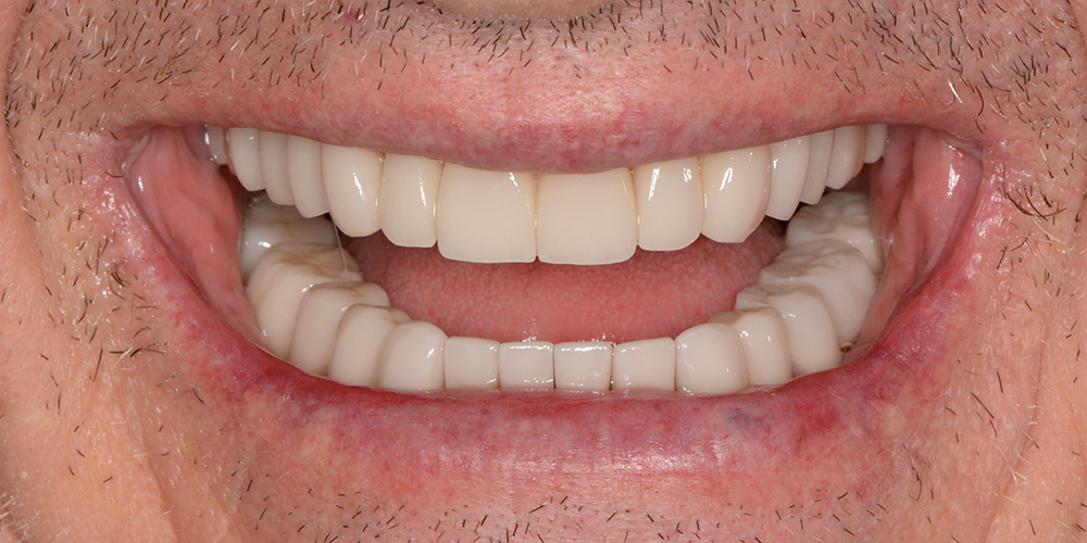 Sorriso depois do tratamento