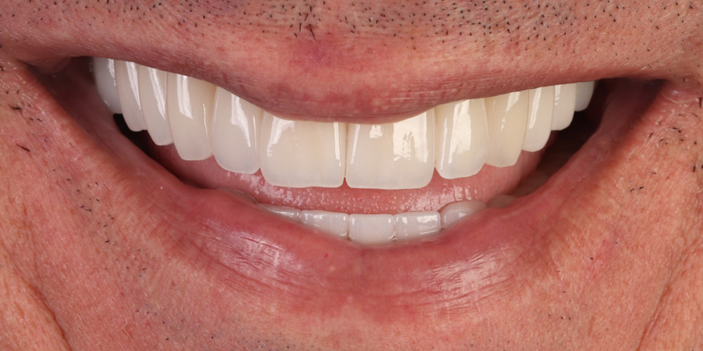 Sorriso depois do tratamento