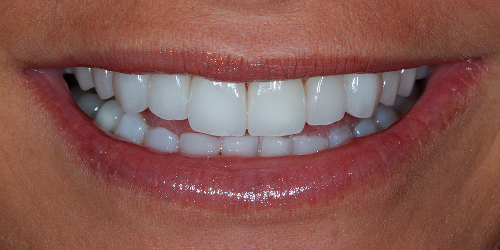 Sorriso depois do tratamento