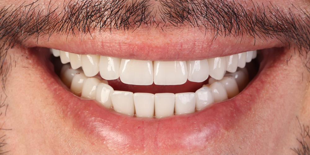 Sorriso depois do tratamento