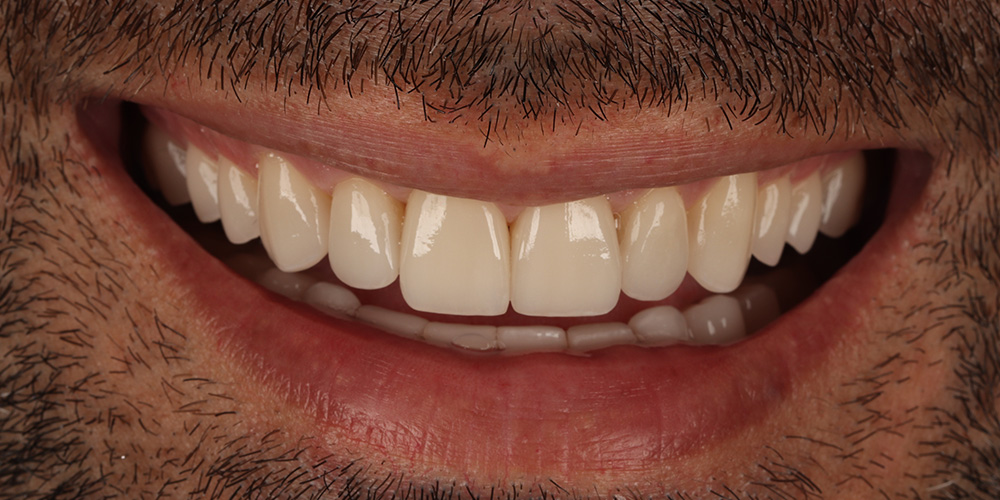Sorriso depois do tratamento