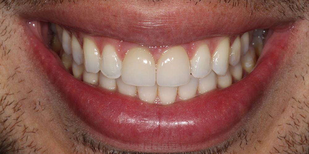 Sorriso depois do tratamento
